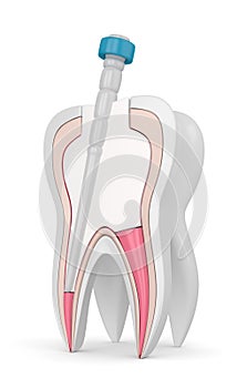 3d render of tooth with gutta percha, fiber post and filling