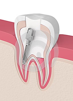 3d render of tooth with gutta percha, post and filling photo