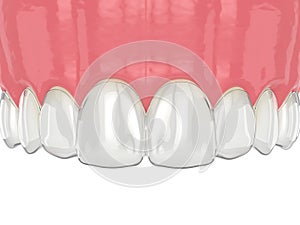 3d render of upper jaw with invisalign removable retainer