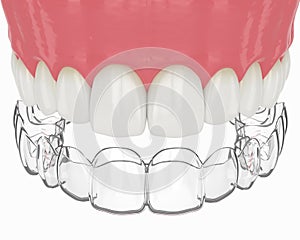 3d render of upper jaw with invisalign removable retainer