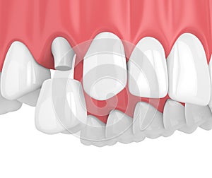 3d render of upper jaw with teeth and dental premolar crown photo