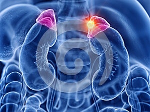 Adrenal gland cancer