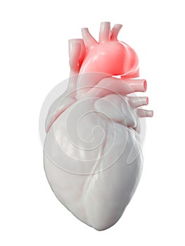 An aortic aneurysm photo