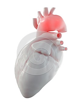 an aortic aneurysm photo