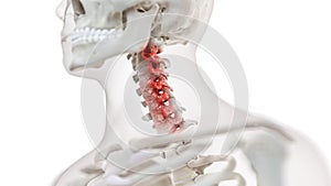 an arthritic cervical spine photo