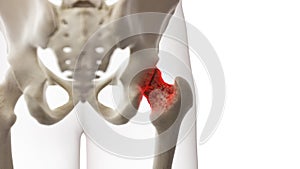 An arthritic hip joint