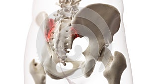 An arthritic iliosacral joint photo