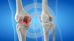 An arthritic knee joint