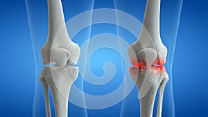 An arthritic knee joint