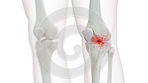 an arthritic knee joint photo