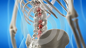 An arthritic lumbar spine photo