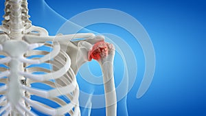 An arthritic shoulder joint photo