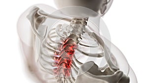 An arthritic thoracic spine photo