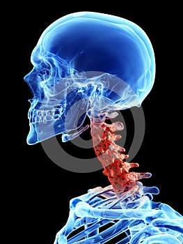 Arthrosis in the cervical spine photo