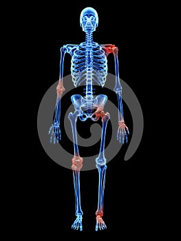 Arthrosis in the joints