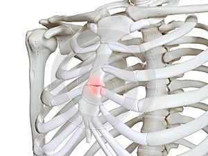 A broken breast bone