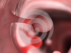 Colon polyps