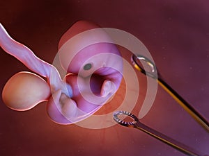 A conceptual abortion situation