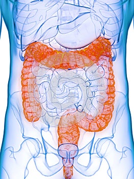A diseased colon photo