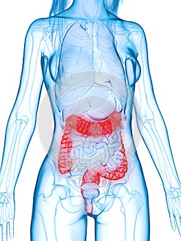 a diseased colon photo