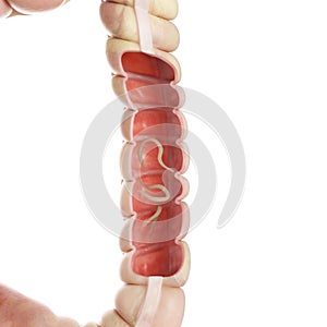 A hookworm in the large human colon