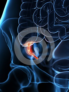 An inflamed appendix photo