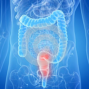 An inflamed rectum photo