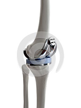 a knee replacement