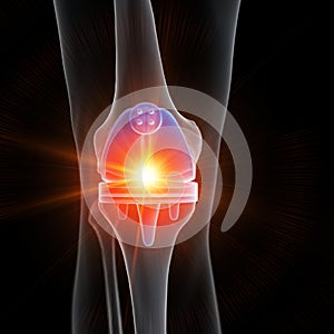 A knee replacement photo