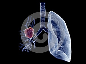 A lung tumor