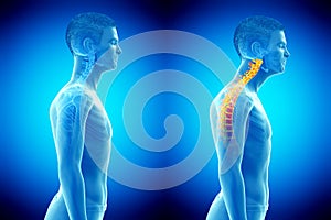 A forward head posture photo