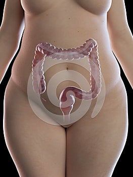 An obese womens colon