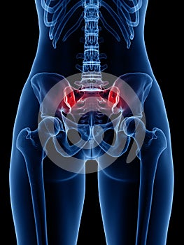 A painful sacroiliac joint