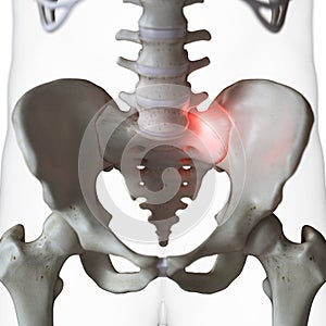 a painful sacrum joint photo