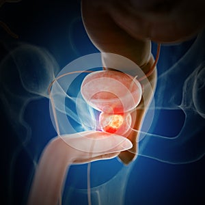 Prostate cancer photo