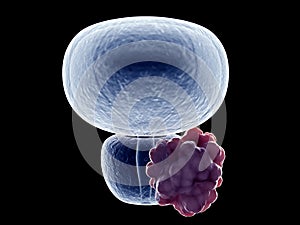 A prostate tumor