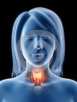 Thyroid cancer
