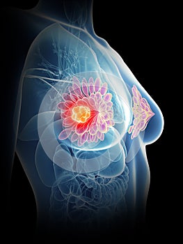 A womans mammary glands cancer photo