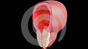 3d rendering of benign prostatic hyperplasia (BPH)