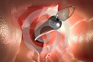 Endoscope remove colonic polyp