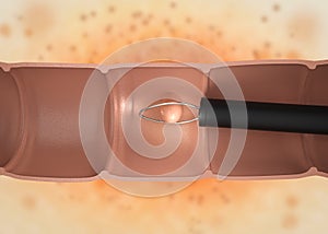 Endoscope remove colonic polyp photo