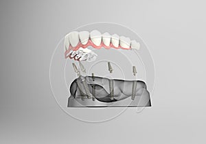 3D rendering teeth