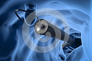 Endoscope remove colonic polyp