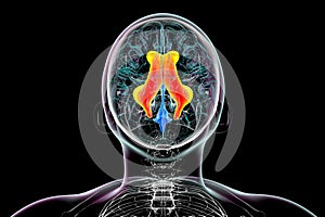 Enlarged lateral ventricles of the brain, 3D illustration photo