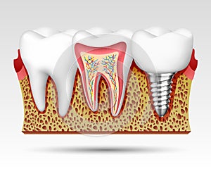 3d teeth in a cut with nerve endings.