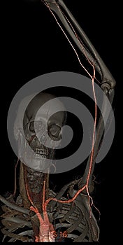 3D upper limb ct angiography photo
