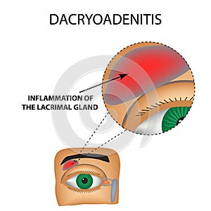 Dacryoadenitis. Inflammation of the lacrimal gland. The structure of the eye. Infographics. photo
