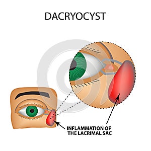 Dacryocyst. Inflammation of the lacrimal sac of the eye. The structure of the eye. Infographics. Vector illustration photo
