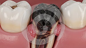 Severely Decayed Tooth with Abscesses and Root Canal Damage image photo