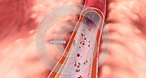 Damage to the endothelium, cholesterol, fats, calcium, and tobacco residue can cause excess waste to become trapped in the artery